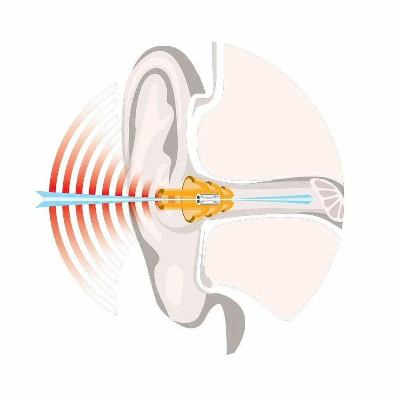 NoNoise Earplugs Travel Noise Filter Ear Protection 5 NoNoise Earplugs Travel Noise Filter Ear Protection - Image 3